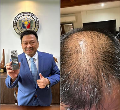 Senator JV Ejercito Shares His Secret ‘wonder solution’ for Hair Growth: Medic Hair for Men